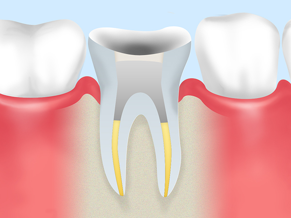 歯の根っこを残す最終手段「根管治療」